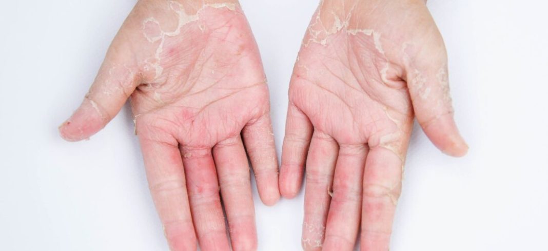 Dermatite de contato: causas, sintomas e cuidados para evitar crises