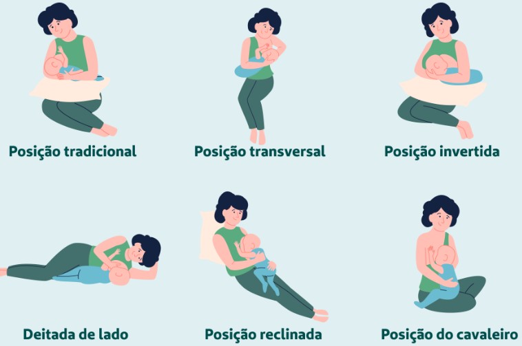Meu leite empedrou: o que fazer para aliviar a dor e continuar amamentando
